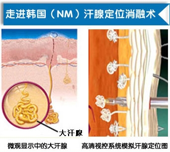 狐臭能治好吗 韩国(改良小切口汗腺清除术)改良小切口汗腺清除术.JPG
