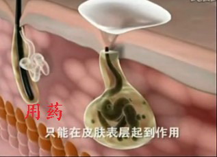 药物无法治好狐臭.JPG